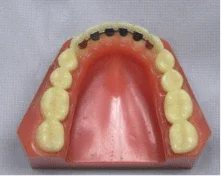 Lingual  Retainer-Dondable second