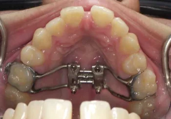MARPE palatal expander with key second