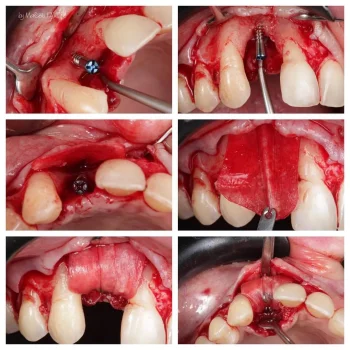 Surgitime Collagen [ Pericardium ] second