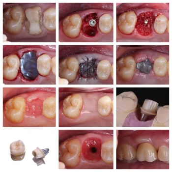 Surgitime Titanium Seal 34*25*0.04MM second