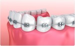 Metal Brackets