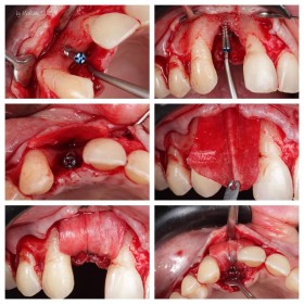 Surgitime Collagen [ Pericardium ]