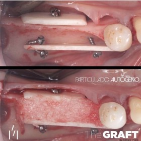 Bonefill Cortical Plate ~ 25 x 10 mm