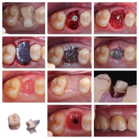 Surgitime Titanium Seal 34*25*0.04MM