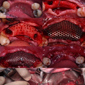 Surgitime Titanium 34 x 25 mm 0,85 mm