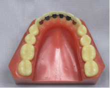 Lingual  Retainer-Dondable